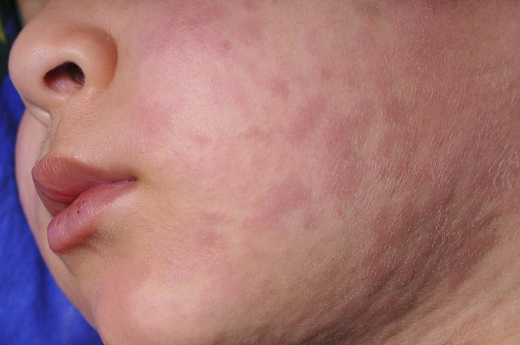 Measles Outbreak in Chicago: CDPH Reports Two New Cases