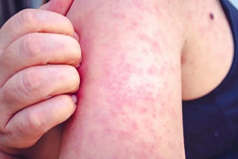 Shoppers at Evergreen Park Sam's Club Possibly Exposed to Measles, CCDPH Warns